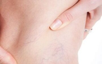 5 راهکار طلایی برای درمان دردهای واریس