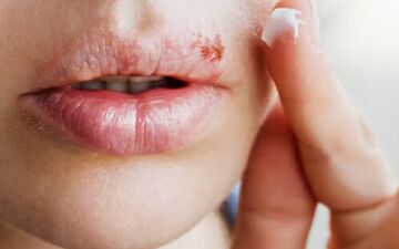 بی حسی یا گزگز لب چقدر جدی است؟

