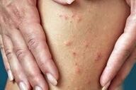 تشخیص مبتلایان به بیماری پوستی گال چگونه است؟