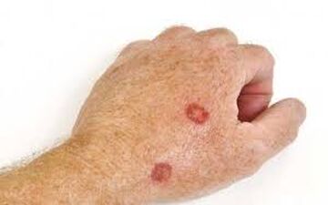 چگونه از سرطان پوست پیشگیری کنیم؟