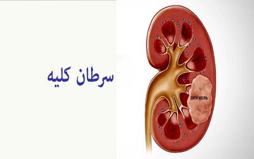 سرطان کلیه: از علائم هشداردهنده تا روش‌های نوین درمان