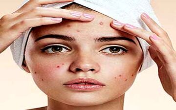 اگر زیاد جوش میزنید این نوشیدنی را مصرف کنید