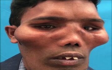 تغییر شکل عجیب صورت مرد جوان در اثر یک عارضه نادر! + فیلم 