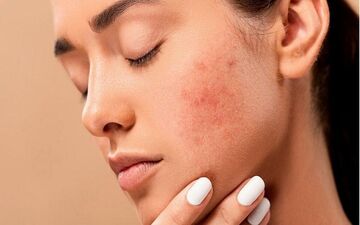 بهترین روش‌های طبیعی برای درمان آکنه