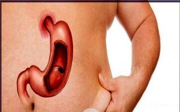 

مزایا و معایب اسلیو معده چیست؟/ حتما بخوانید



