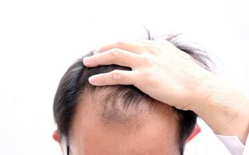 چرا موها می‌ریزند؟ دلایل شایع ریزش مو