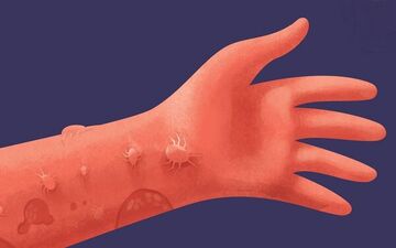 احساس حرکت حشره روی بدن نشانه ابتلا به این بیماری است