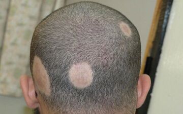 درباره ریزش موی سکه ای بیشتر بدانید