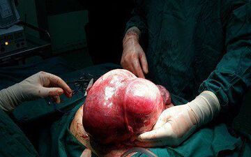 توده پنج کیلویی از شکم دختر ۱۳ ساله خارج شد