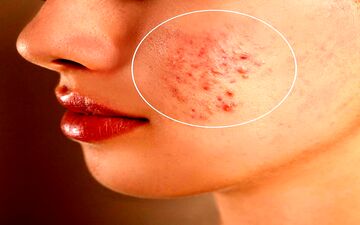 پوست چرب دارید؟ این ۸ باور غلط را دور بریزید